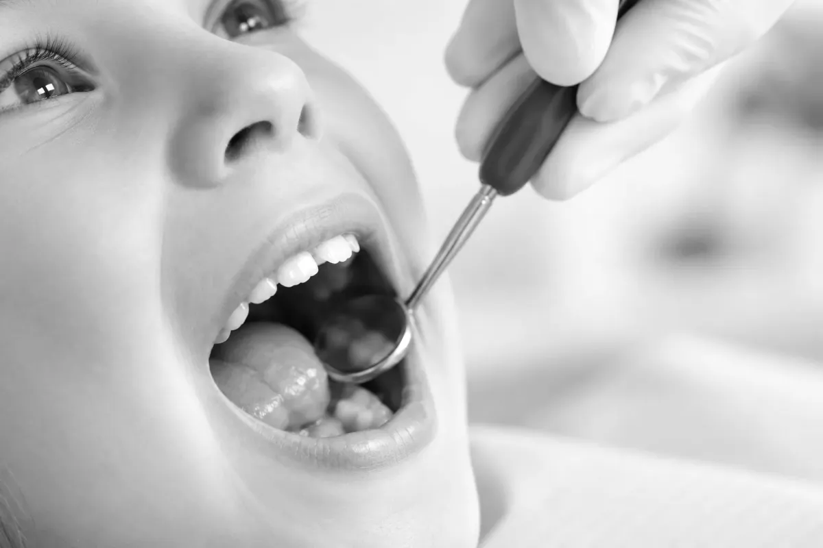 A child’s mouth being checked with a dental mirror