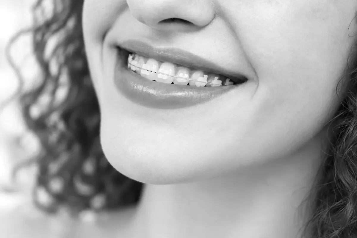 A smile with ceramic braces