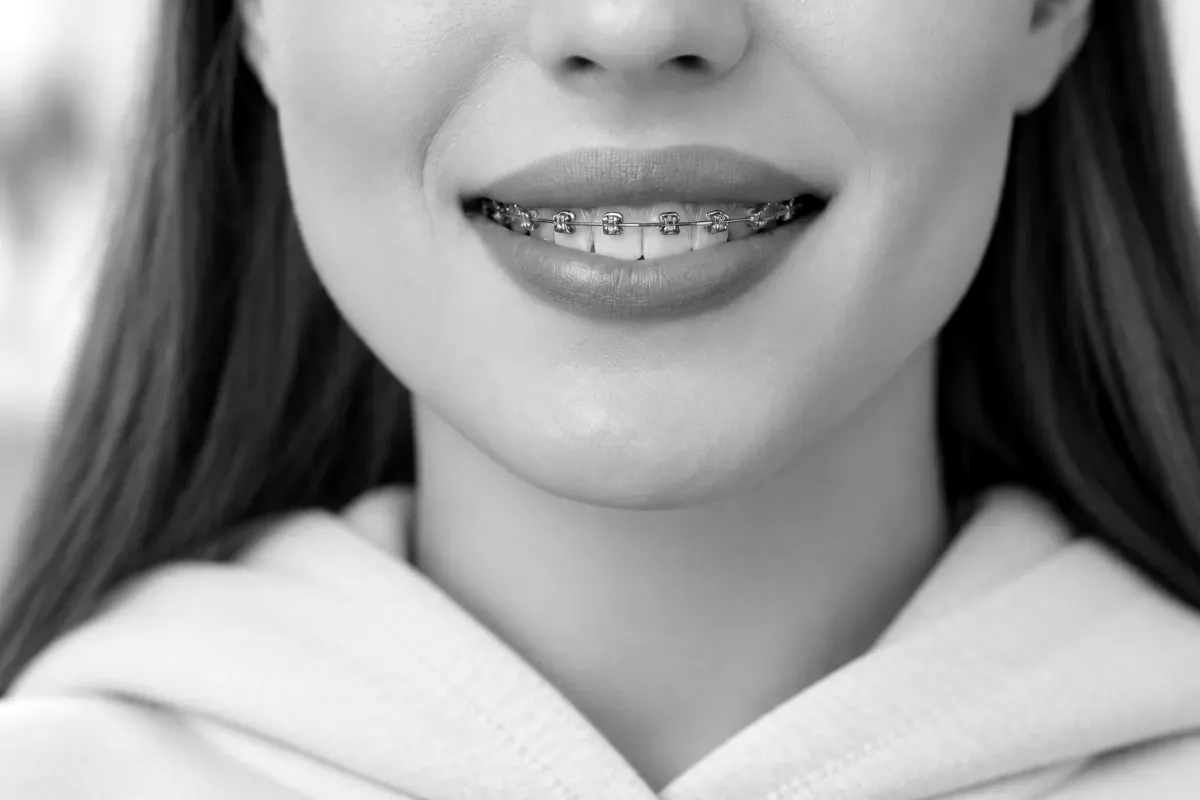 A close view of self-ligating braces