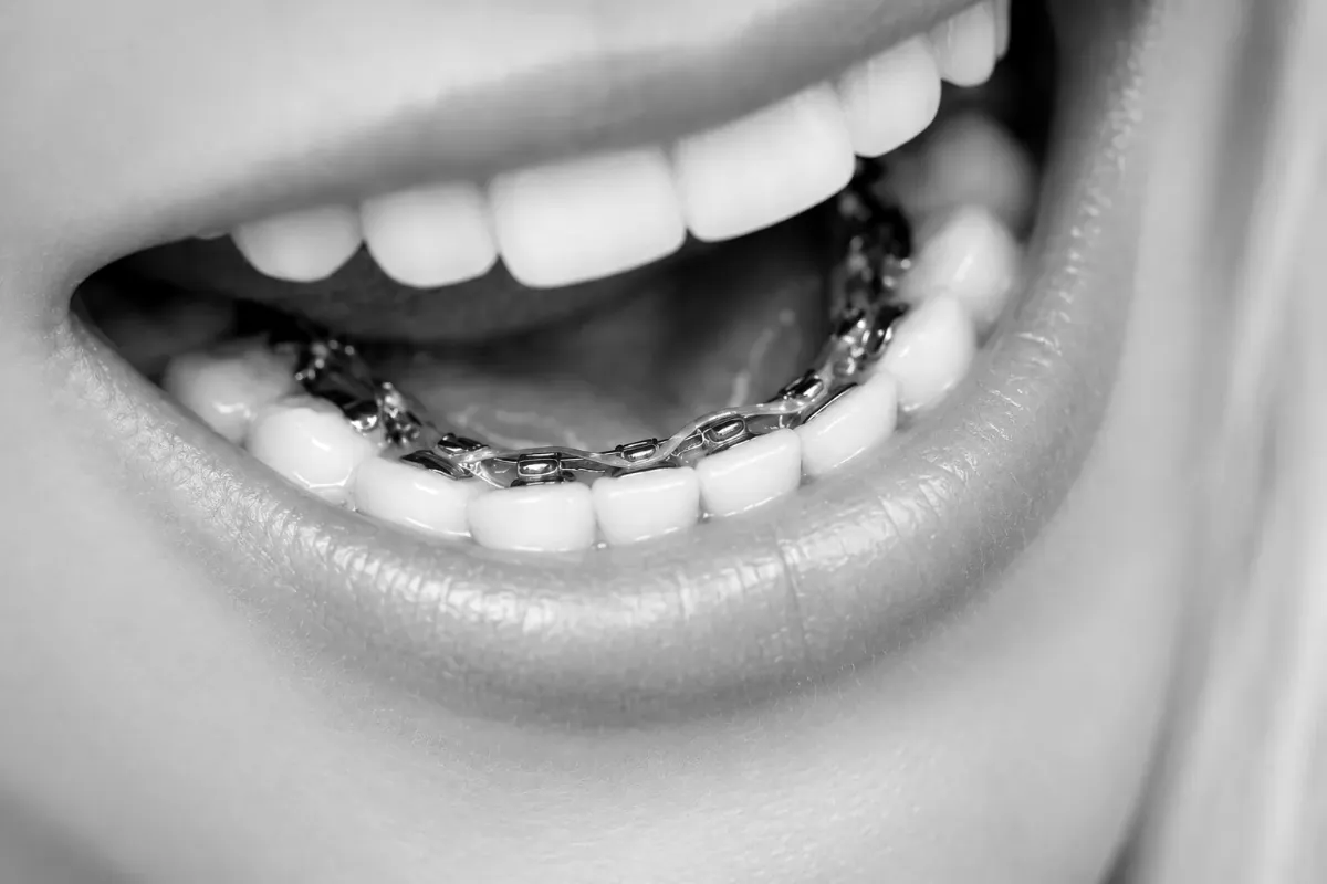 Lingual braces on the inside surface of the teeth