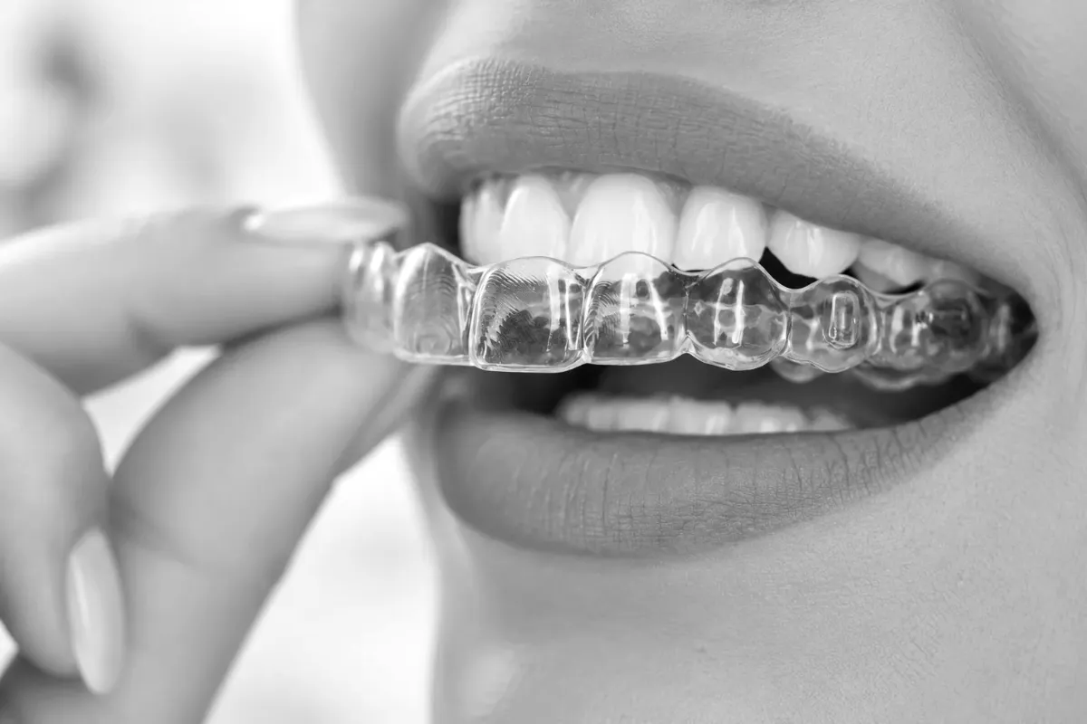 A patient placing a clear Invisalign aligner
