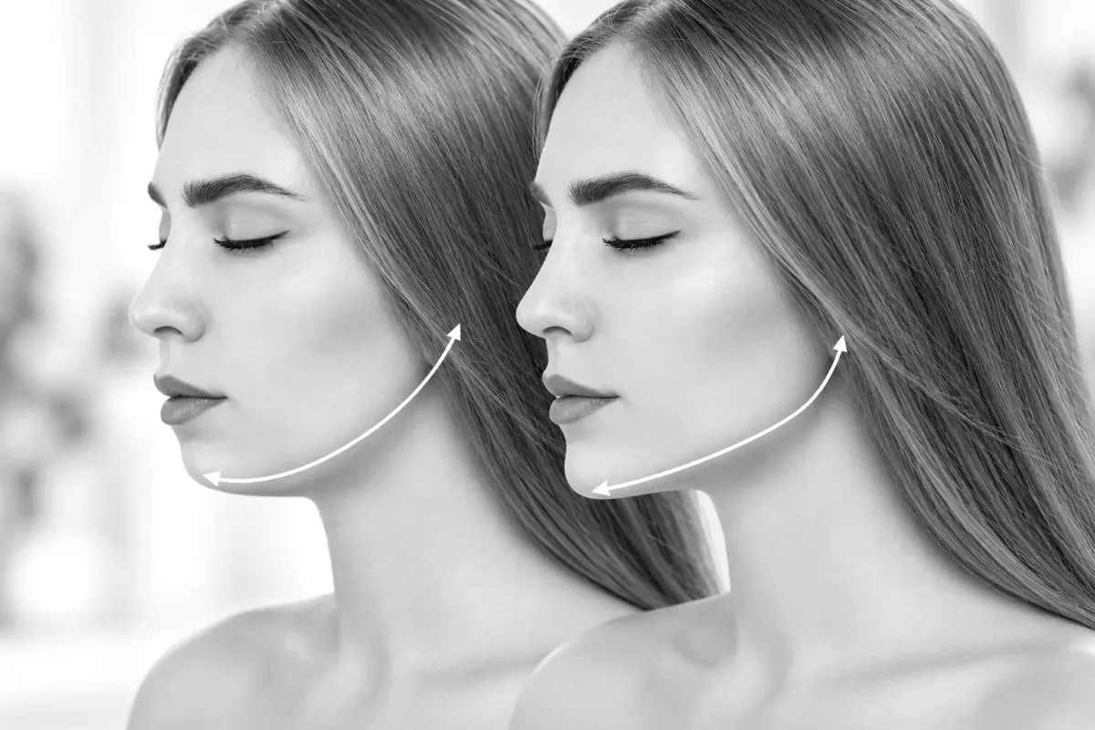Profile views used in jaw-surgery treatment planning