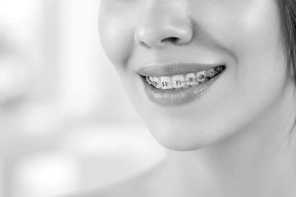 A smile with metal braces