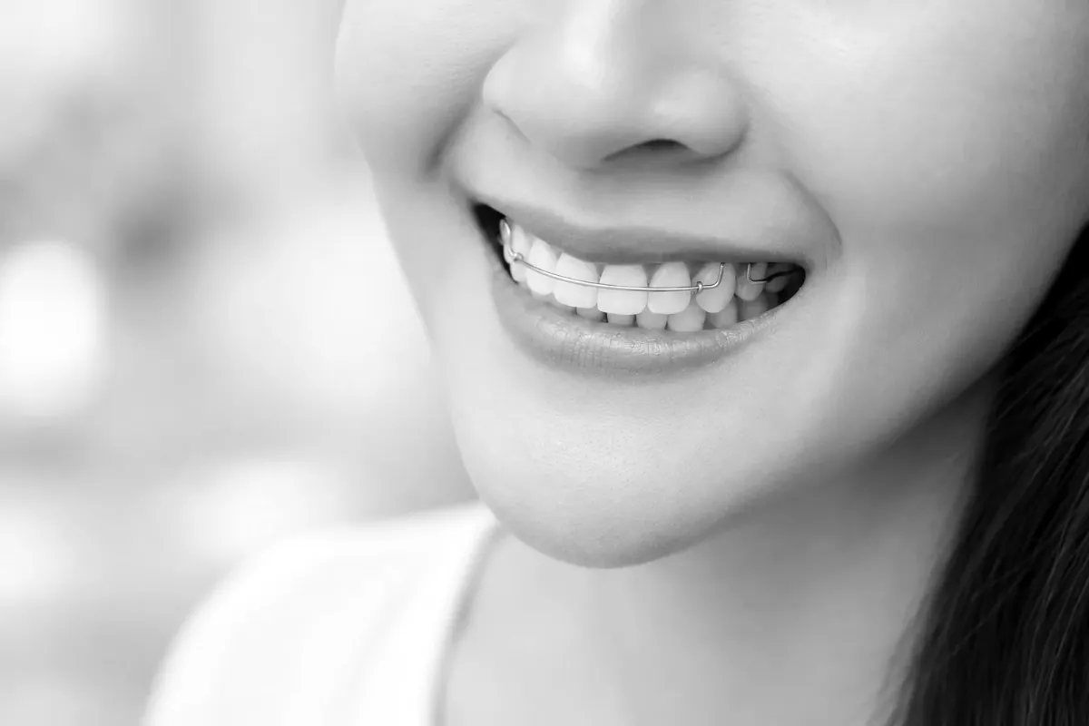 A smile with a clear retainer in place