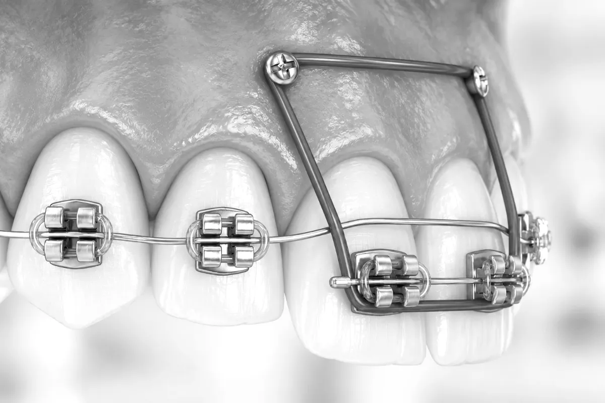 A dental model showing a temporary anchorage device with braces