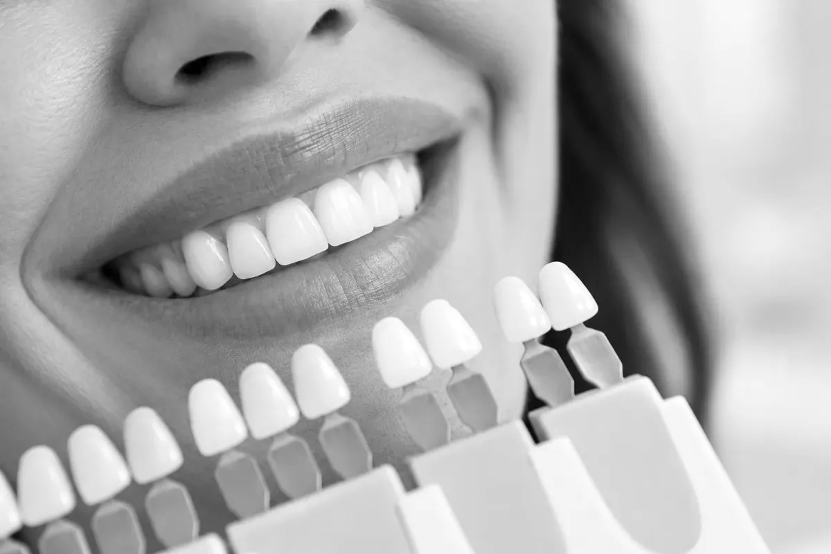 A whitening shade guide held beside a smile