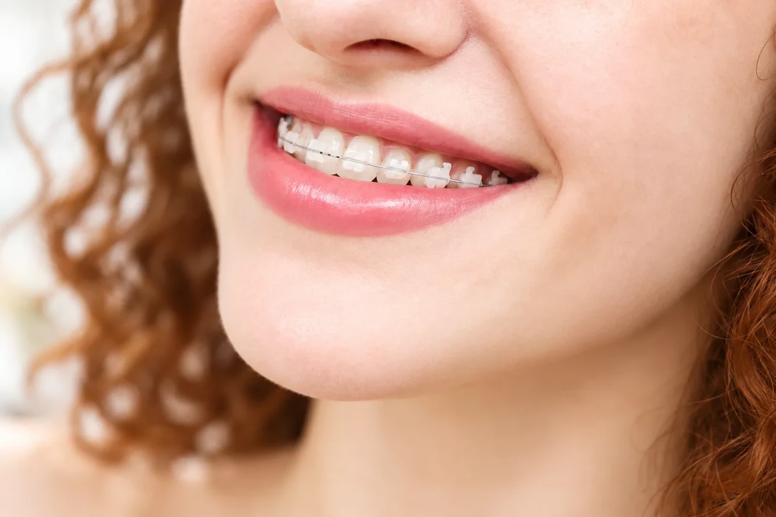 A close view of tooth-colored ceramic brackets and the thin wire across them.